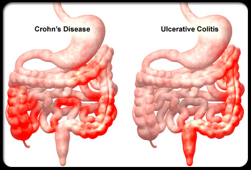 doença de crohn e colite ulcerativa diferenças