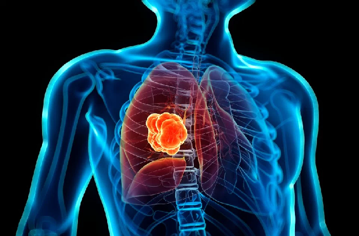 Projeto Inspire torna mais eficaz diagnóstico e tratamento de câncer de pulmão