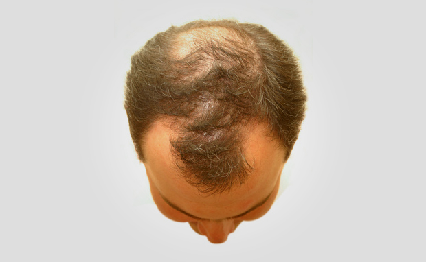 Alopecia