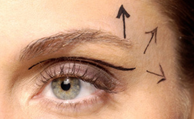 Blefaroplastia