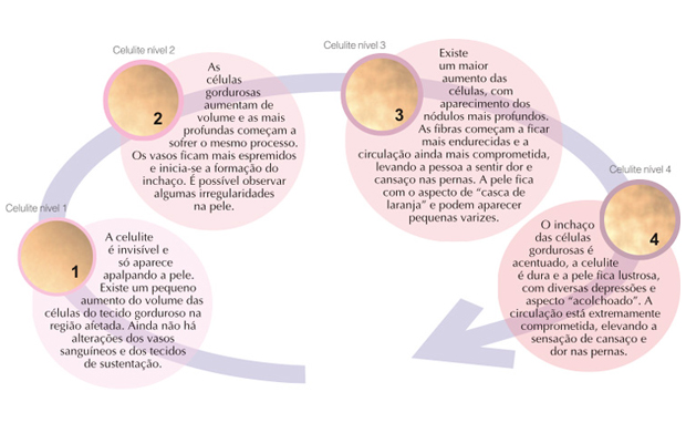 Informações sobre o tratamento para os quatro graus de celulite