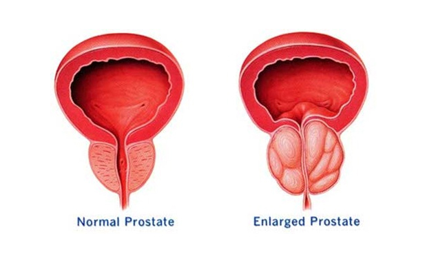 Hiperplasia benigna de próstata