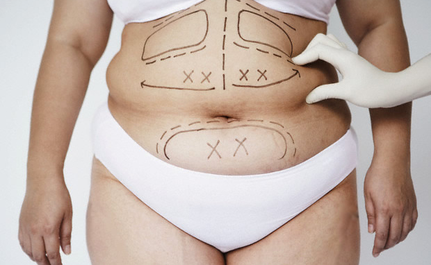 Lipoabdominoplastia