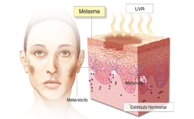 Tratamento de mancha melasma