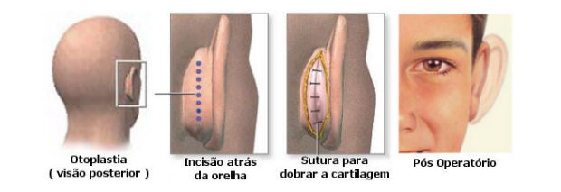 Otoplastia