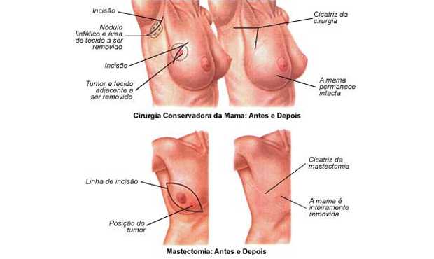 Reconstrução mamária