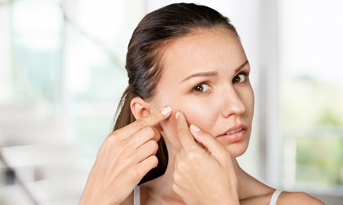 Rotina para acabar com a vermelhidão e inchaço da acne severa