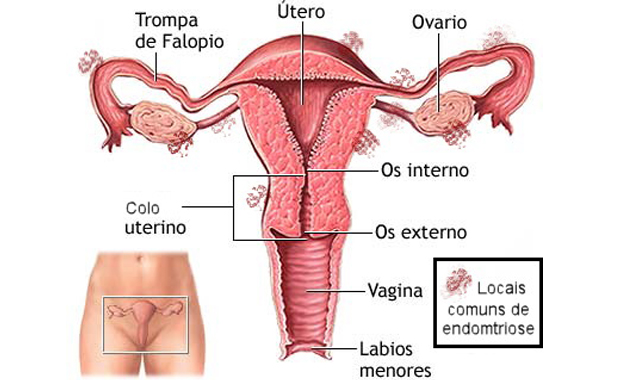 endometriose diagrama endometriose