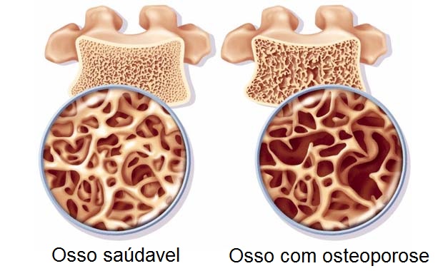 Osteoporose