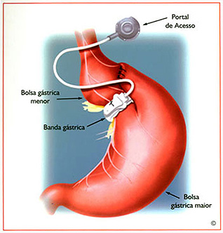Redução de Estômago