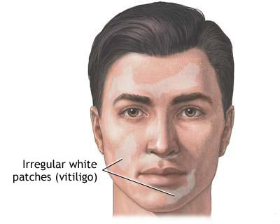 Vitiligo