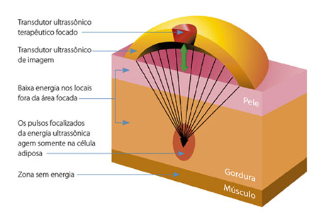 tratamento ultrashape gordura localizada