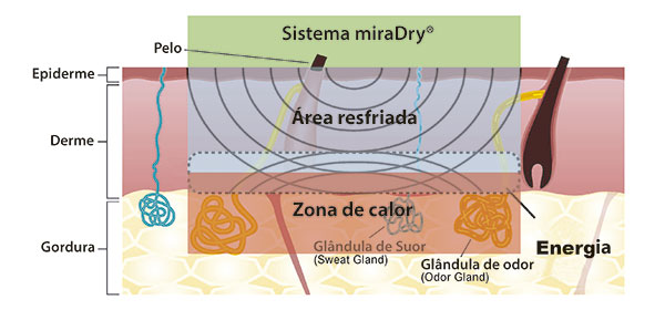 esquema da pele mostra a atuação do miradry durante o tratamento da hiperidrose