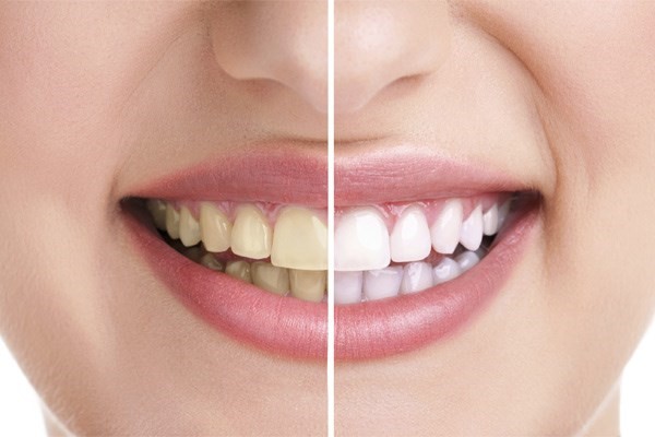 Clareamento Dental