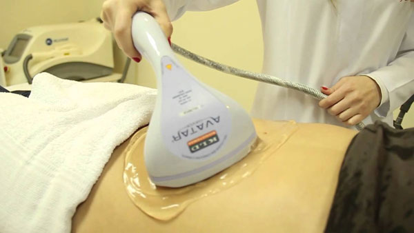 Ultracavitação: um tratamento que promete fazer você dar adeus aos pneuzinhos