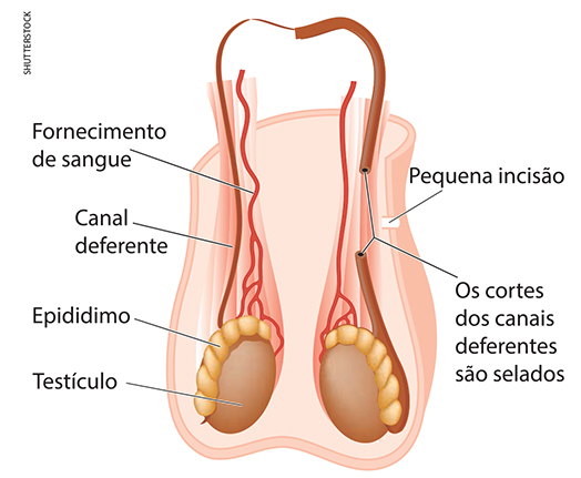 Como funciona a cirurgia e pós-operatório da vasectomia